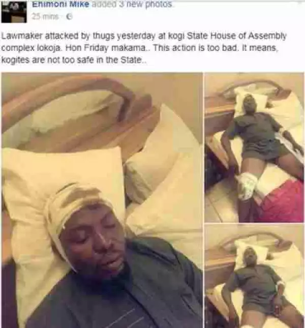 OMG! See What This Lawmaker Looks Like After Attack By Thugs At Kogi House Of Assembly
